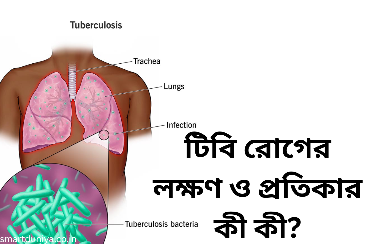 টিবি রোগের লক্ষণ ও প্রতিকার কী কী?